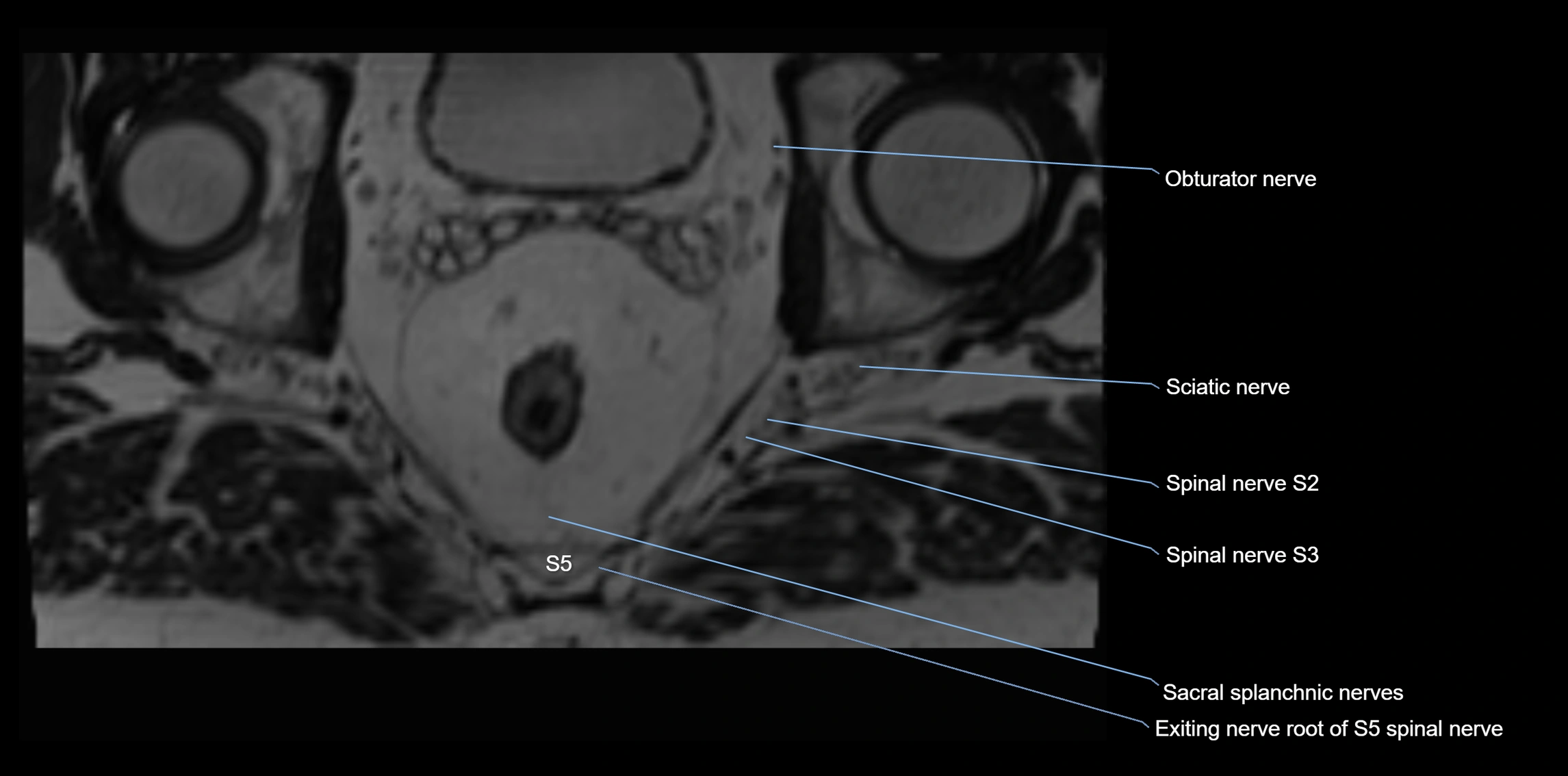 MR lumbosacral plexus axial cross sectional anatomy 3T  radiology  image-img-1008001-00115.webp